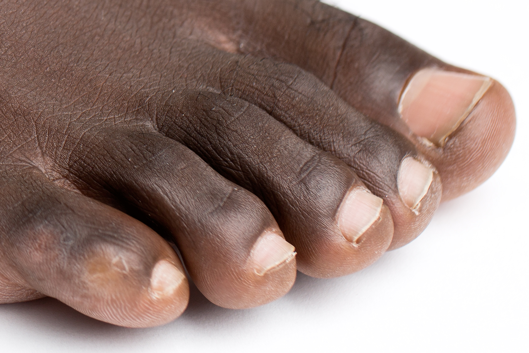 Toe