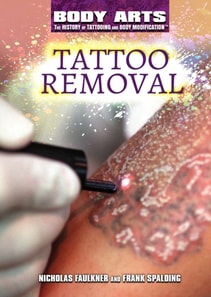 Tattoo Removal