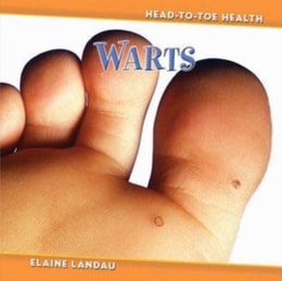 Warts