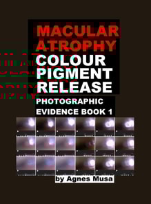 Macular Atrophy Colour Pigment Release, Photographic Evidence Book 1