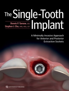 Single-Tooth Implant: