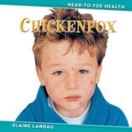 Chickenpox