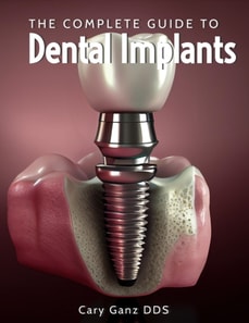 Complete Guide to Dental Implants
