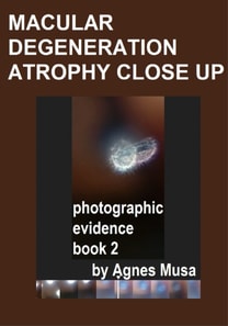 Macular Degeneration Atrophy Close Up, Photographic Evidence Book 2