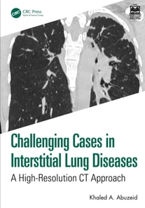 Challenging Cases in Interstitial Lung Diseases