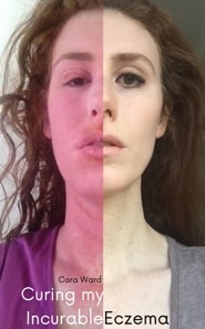 Curing my Incurable Eczema: My Topical Steroid Withdrawal (TSW) Journey