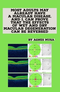 Most Adults May Already Have A Macular Disease, And I, Can Prove That The Effects Of Wet And Dry Macular Degeneration Can Be Reversed