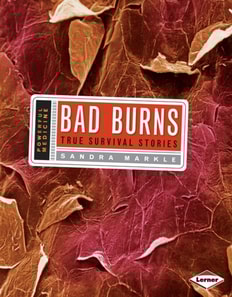 Bad Burns