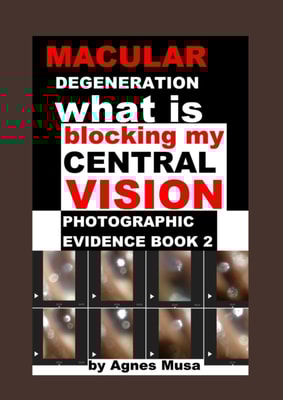 Macular Degeneration, What Is Blocking My Central Vision, Photographic Evidence Book 2