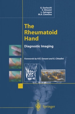Rheumatoid Hand