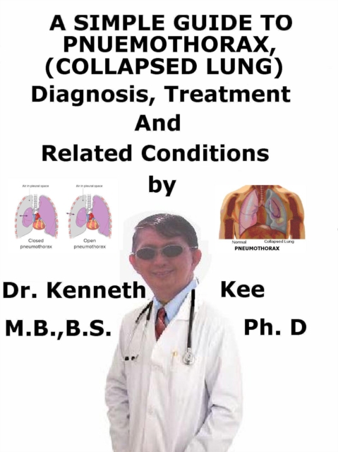 Simple Guide to Pneumothorax (Collapsed Lungs), Diagnosis, Treatment and Related Conditions