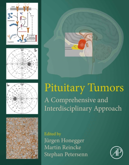 Pituitary Tumors