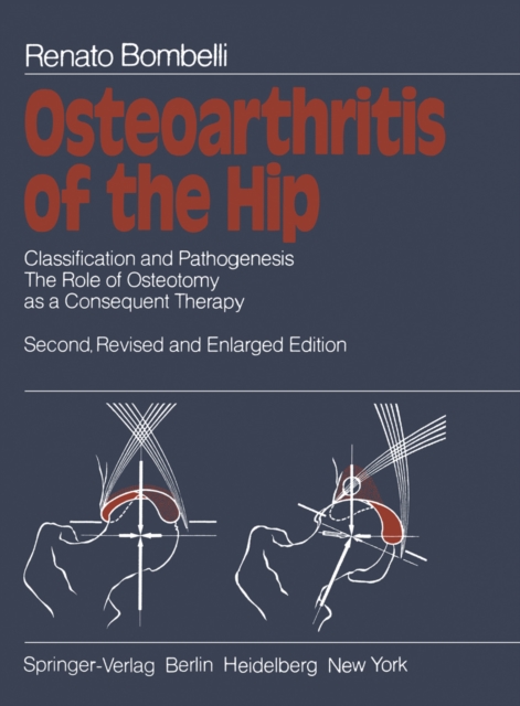 Osteoarthritis of the Hip