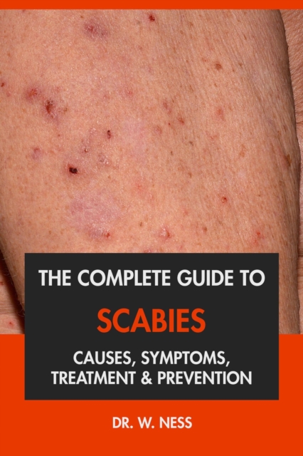 Complete Guide to Scabies: Causes, Symptoms, Treatment & Prevention