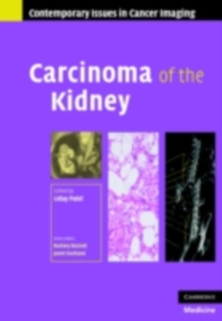 Carcinoma of the Kidney