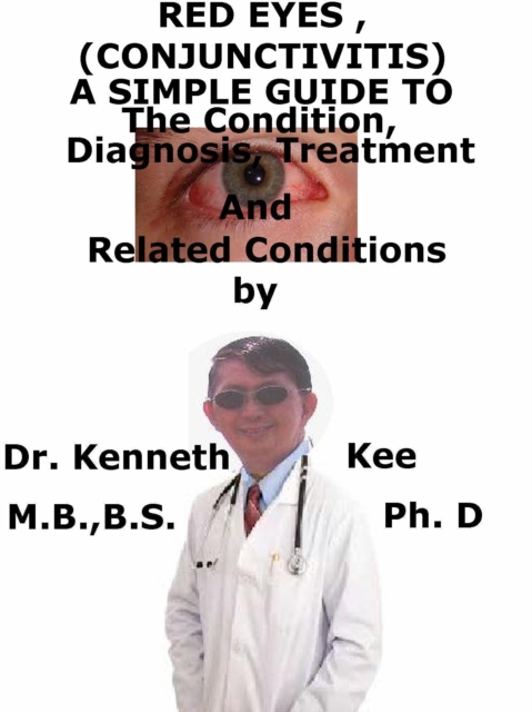 Red Eyes (Conjunctivitis), A Simple Guide To The Condition, Diagnosis, Treatment And Related Conditions