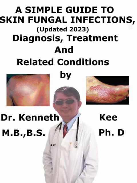 Simple Guide to Skin Fungal Infections, (Updated 2023) Diagnosis, Treatment and Related Conditions