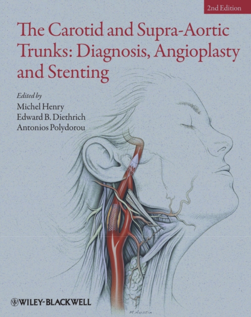 Carotid and Supra-Aortic Trunks