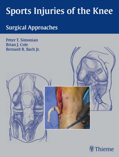 Sports Injuries of the Knee