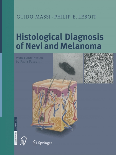 Histological Diagnosis of Nevi and Melanoma