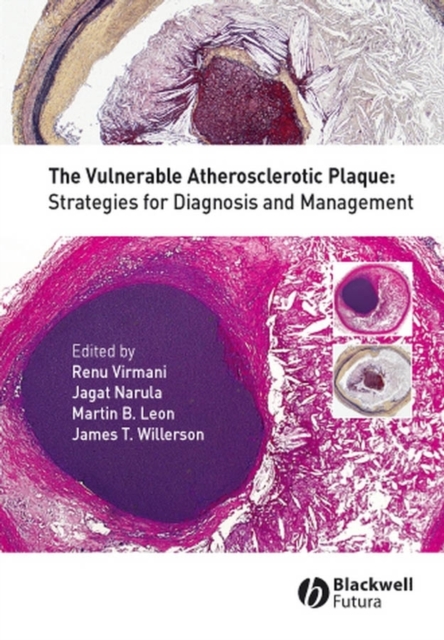 Vulnerable Atherosclerotic Plaque
