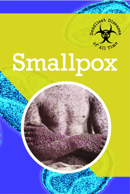 Smallpox