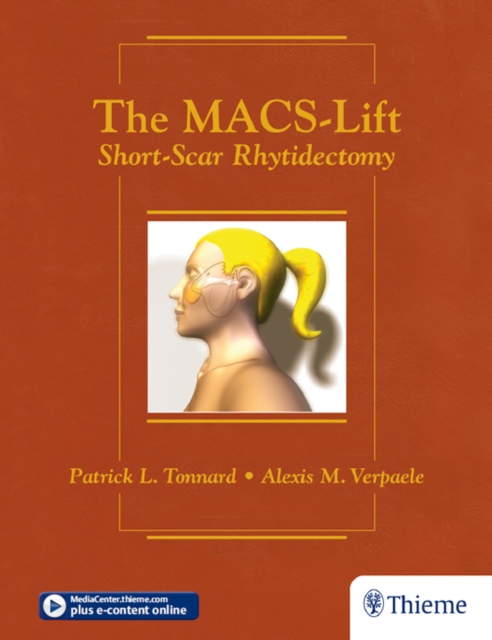 MACS-Lift