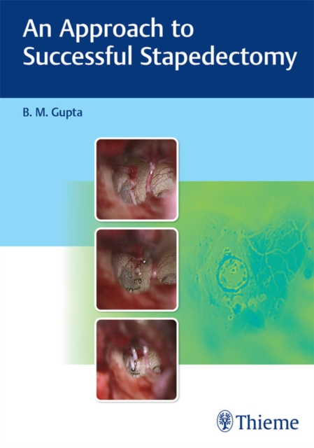 Approach to Successful Stapedectomy