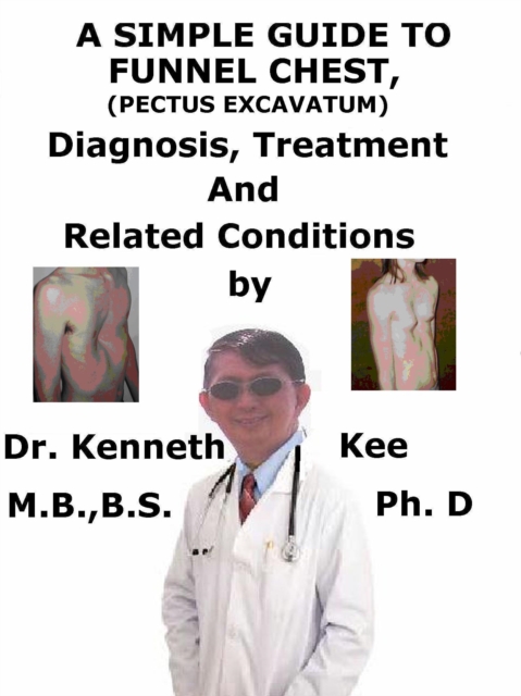 Simple Guide to Funnel Chest (Pectus Excavatum), Diagnosis, Treatment and Related Conditions