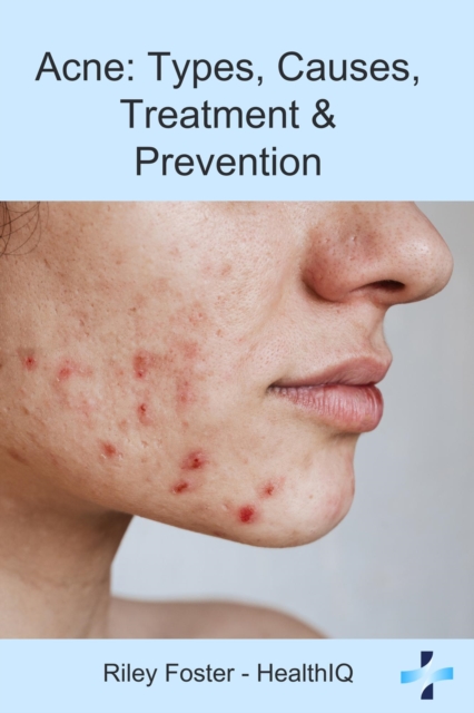 Acne: Types, Causes, Treatment & Prevention