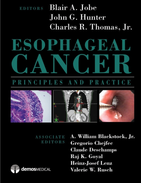 Esophageal Cancer