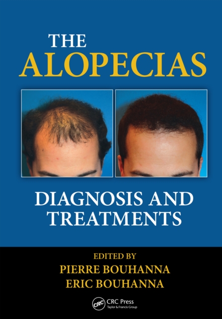 Alopecias