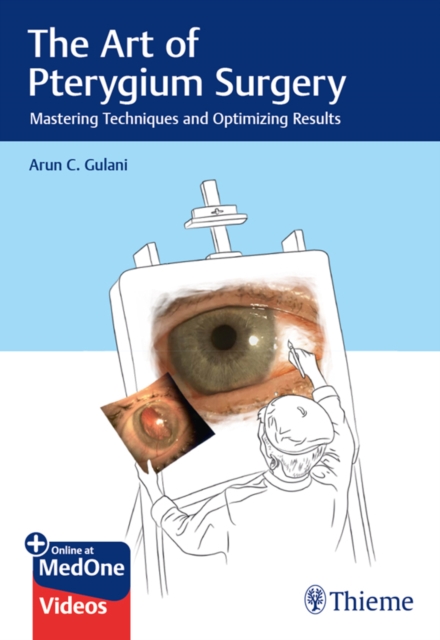 Art of Pterygium Surgery
