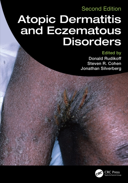 Atopic Dermatitis and Eczematous Disorders