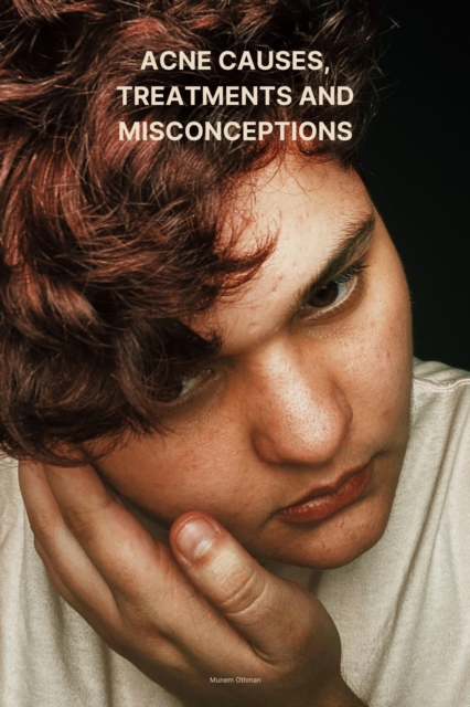 Acne causes,  treatments and misconceptions
