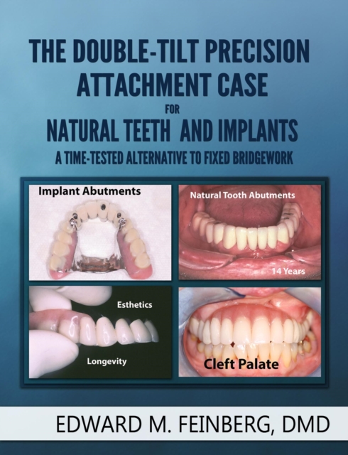 Double-Tilt Precision Attachment Case for Natural Teeth and Implants