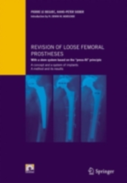 Revision of loose femoral prostheses with a stem system based on the "e;press-fit"e; principle