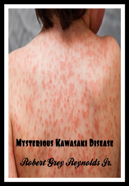 Mysterious Kawasaki Disease