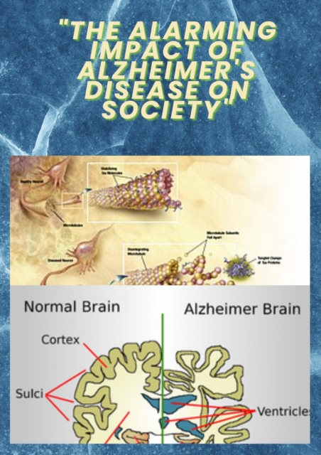 &quote;The Alarming Impact of Alzheimer's Disease on Society&quote;