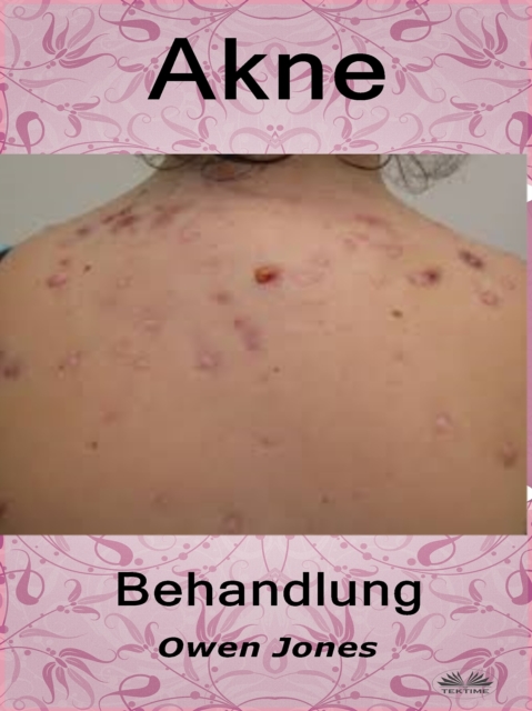 Akne-Behandlung
