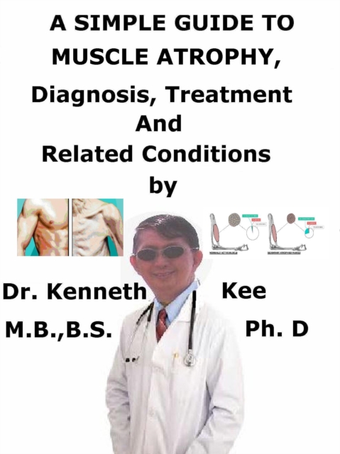 Simple Guide to Muscle Atrophy, Diagnosis, Treatment and Related Conditions