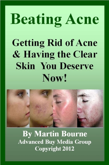 Beating Acne: Getting Rid of Acne & Having the Skin You Deserve Now!