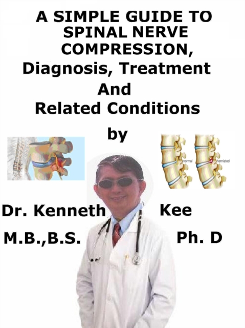 Simple Guide to Spinal Nerve Compression, Diagnosis, Treatment and Related Conditions