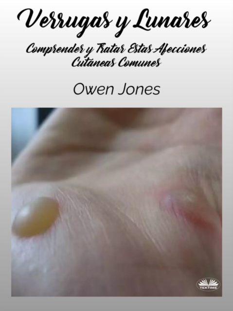Verrugas Y Lunares